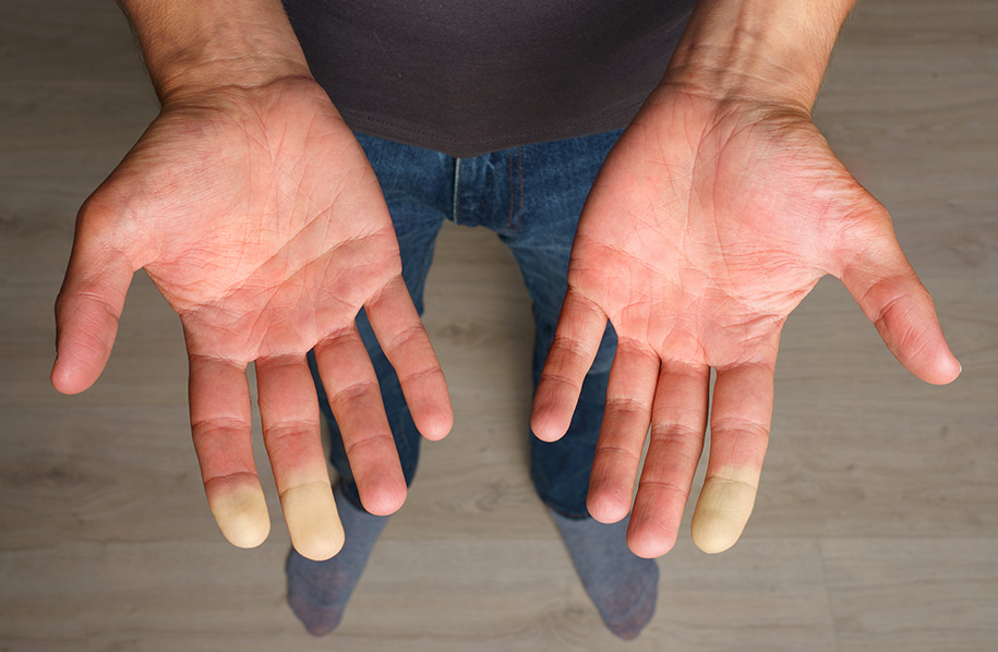 acrosyndrome